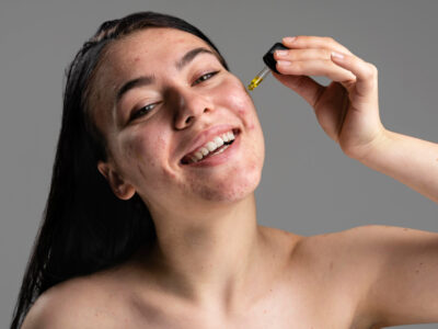 איך להיפטר מחצ'קונים בדרך טבעית