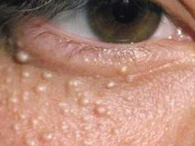 Milia-Diagnosis-and-treatment