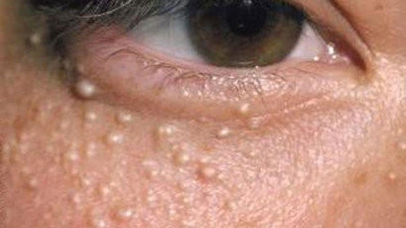 Milia-Diagnosis-and-treatment